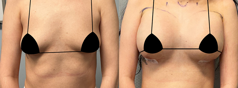 Breast Augmentation Before and After 