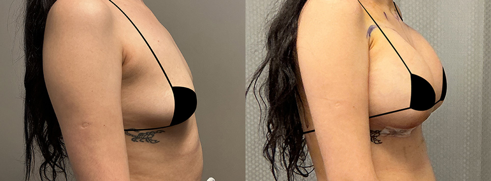 Breast Augmentation Before and After 