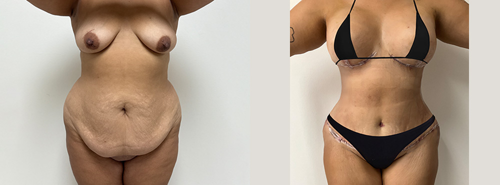 Mommy Makeover Before and After in miami