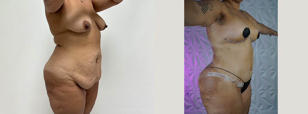 Mommy Makeover Before and After in miami