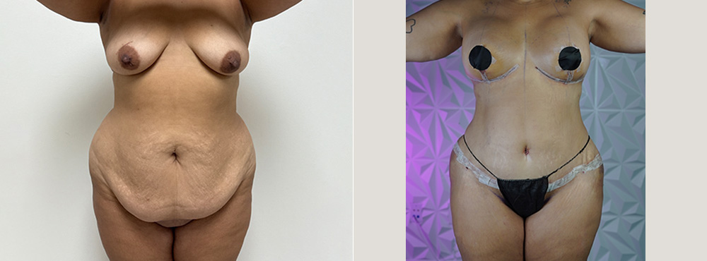 Mommy Makeover Before and After in miami