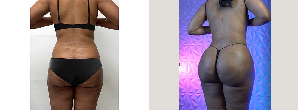 Brazilian Butt Lift before and after