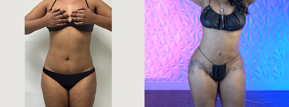 Brazilian Butt Lift before and after