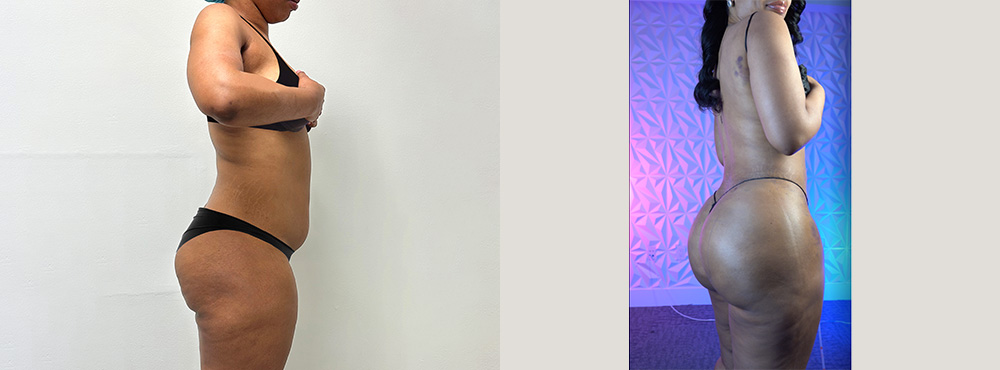 Brazilian Butt Lift before and after