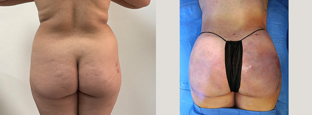 Mommy Makeover Before and after