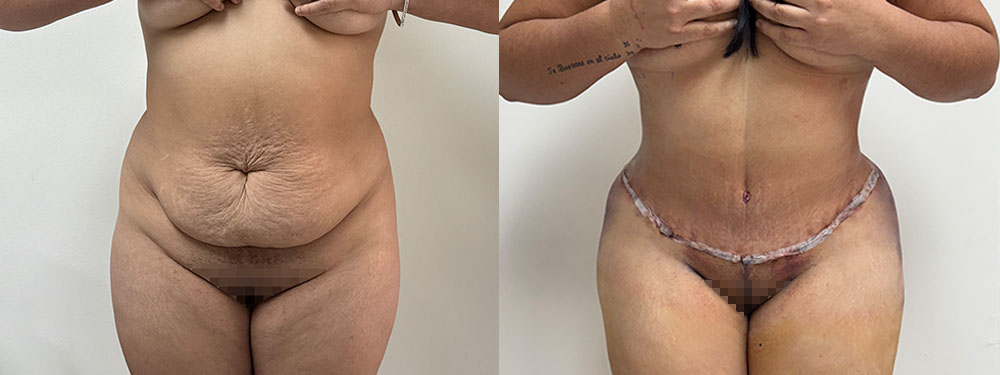 Mommy Makeover Before and after