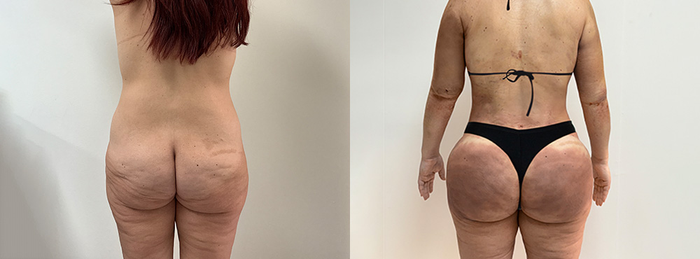 Brazilian Butt Lift Before and After