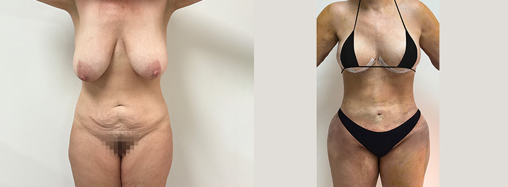 Brazilian Butt Lift Before and After