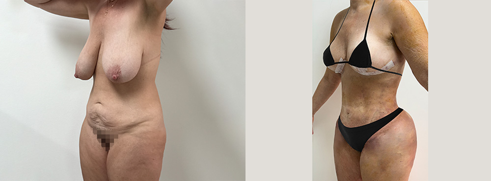 Brazilian Butt Lift Before and After