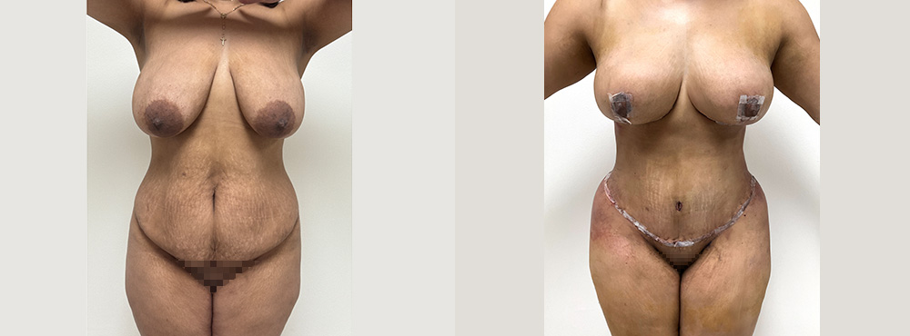 Mommy Makeover Before and After