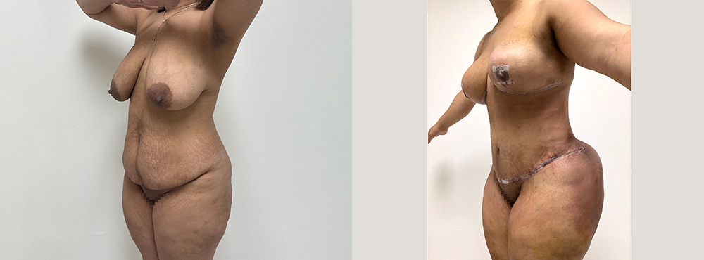 Mommy Makeover Before and After