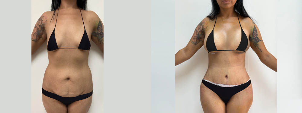 Mommy Makeover Before and After