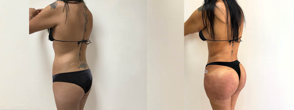 Mommy Makeover Before and After