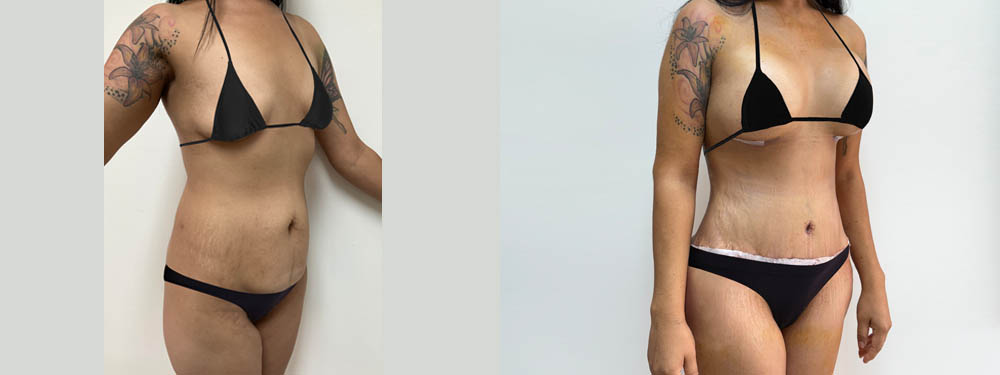 Mommy Makeover Before and After