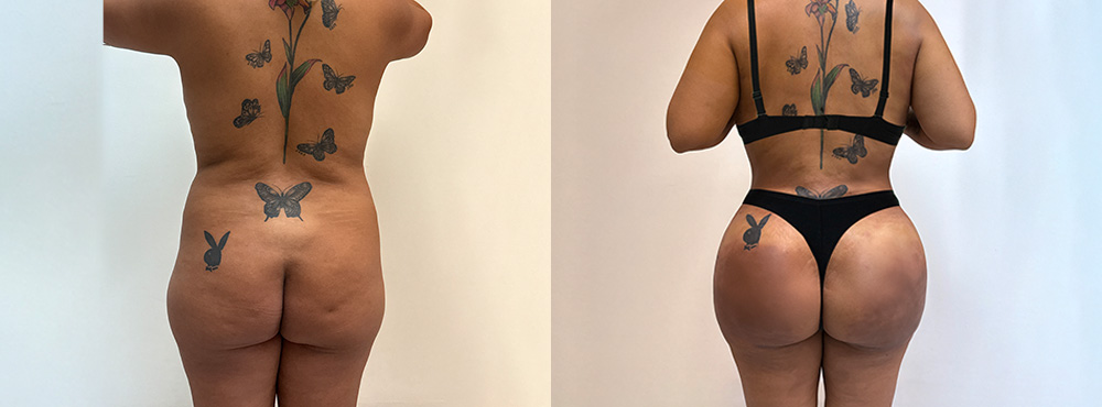 Brazilian Butt Lift Before and After