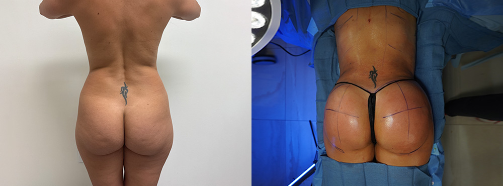 Mommy Makeover Before and After