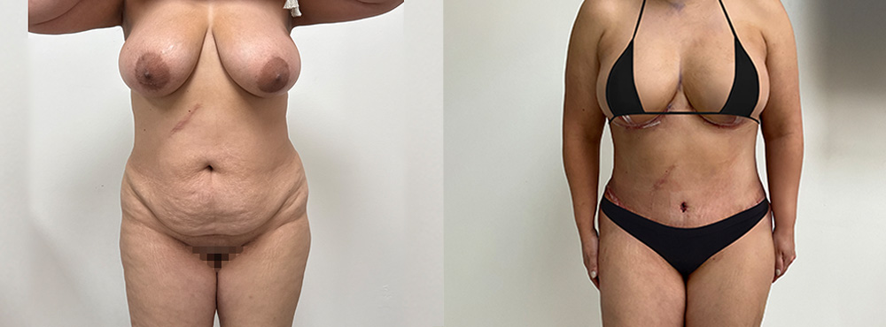 Mommy Makeover Before and After