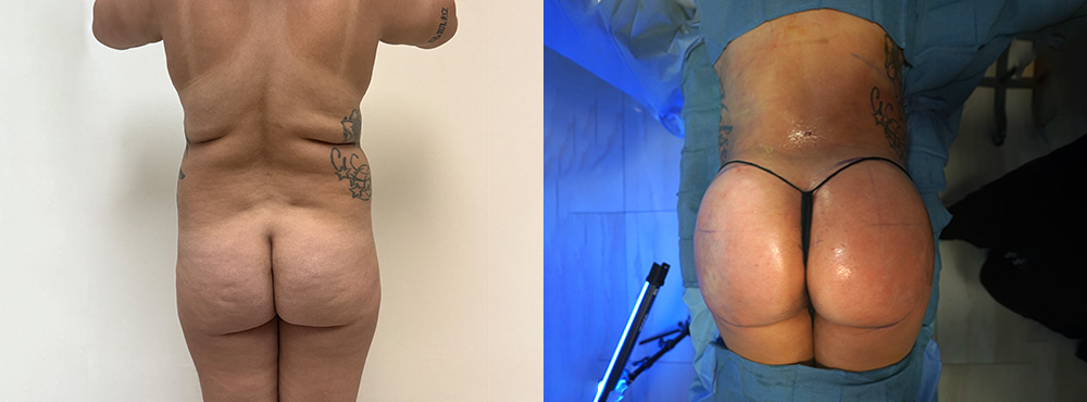 Brazilian Butt Lift Before and After