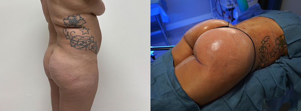 Brazilian Butt Lift Before and After
