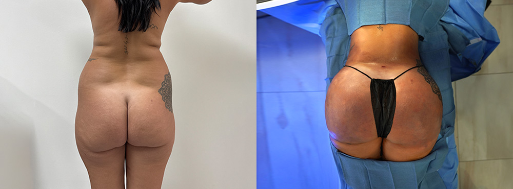 Brazilin Butt Lift Before and After