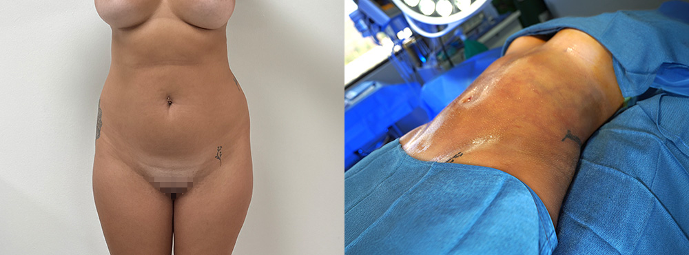 Brazilin Butt Lift Before and After