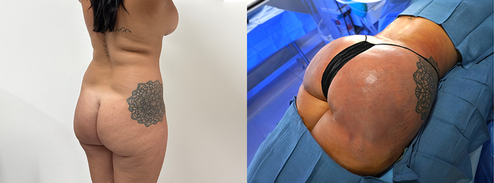 Brazilin Butt Lift Before and After