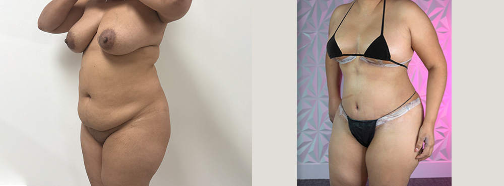 Mommy Makeover Before and after