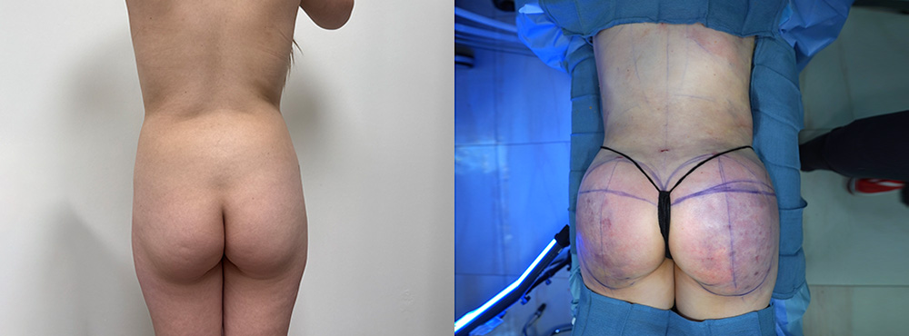 Butt Lift Before and After in Miami