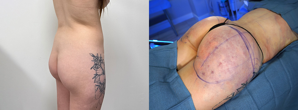 Butt Lift Before and After in Miami