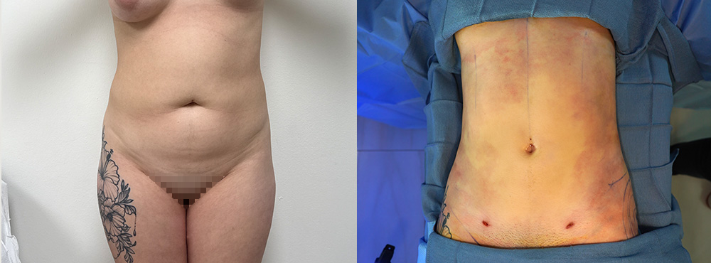 Butt Lift Before and After in Miami