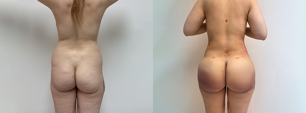 Brazilian Butt Lift Before and After