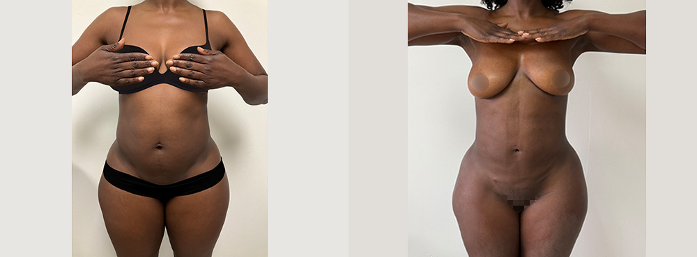 Lipo 360 before and After in Miami