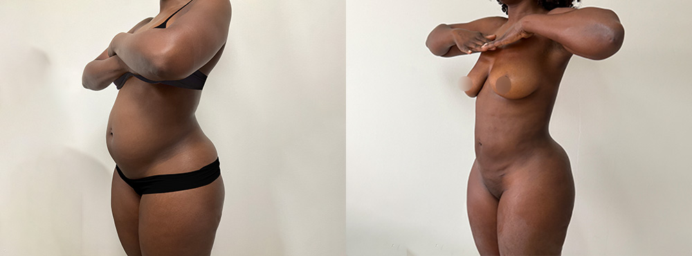 Lipo 360 before and After in Miami