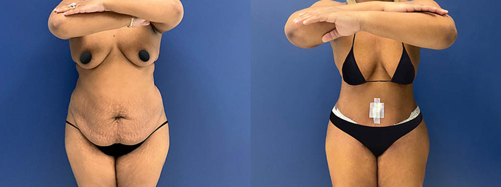 Tummy Tuck Before and After in Miami