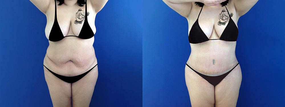 Mommy Makeover Before and After in Miami