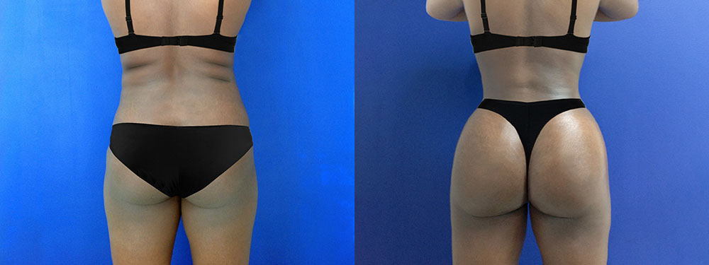Butt Lift Before and After