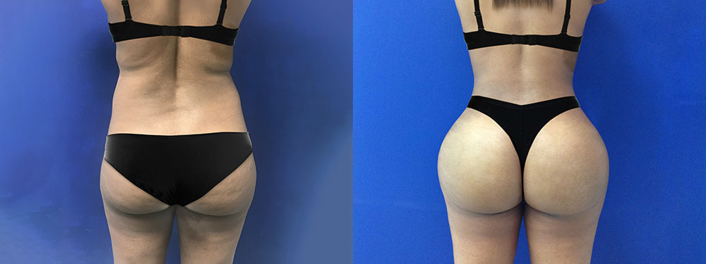 Brazilian Butt LIft Before and After