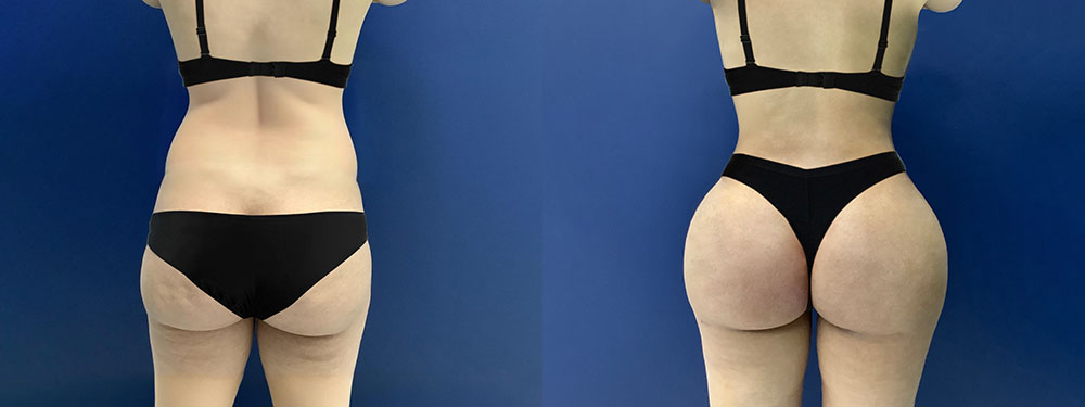 Brazilian Butt Lift Before and After