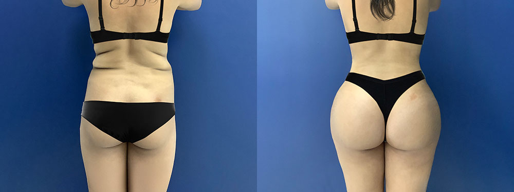 Brazilian Butt Lift Before and After