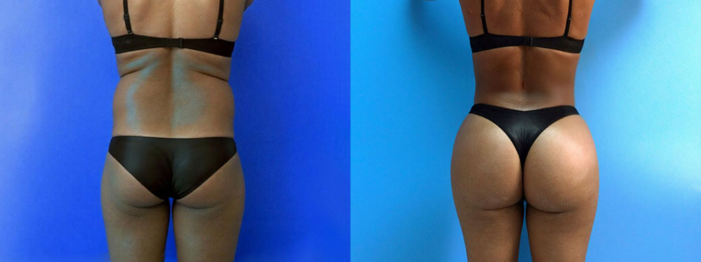 Brazilian Butt Lift Before and After