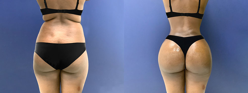 Butt Lift in Miami
