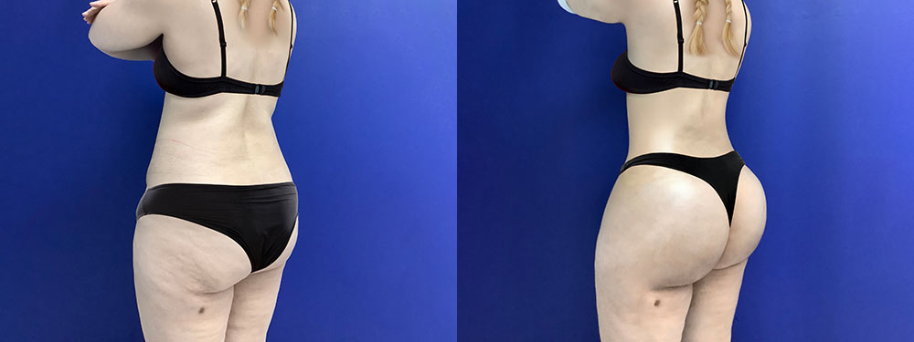 Brazlian Butt Lift before and after