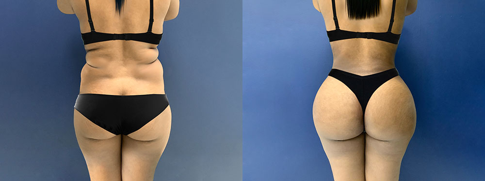 Brazilian Butt Lift Before and After in Miami