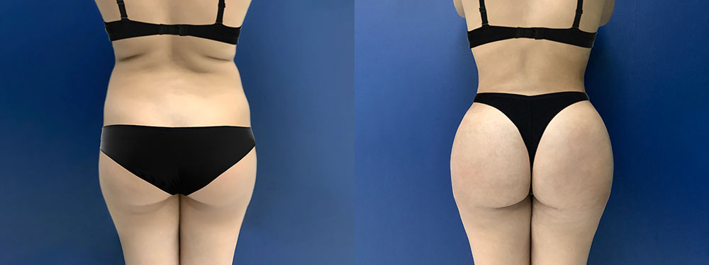 Brazlian Butt Lift Before and After