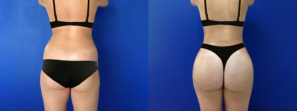 Brazlian Butt Lift Before and after