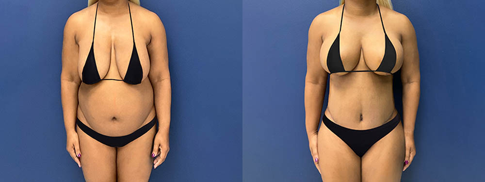 Mommy Makeover Before and After in Miami