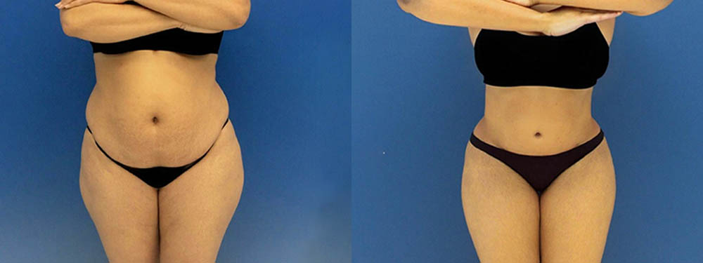 Tummy Tuck Before and After
