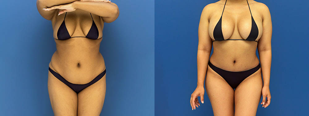 Mommy Makeover Before and After