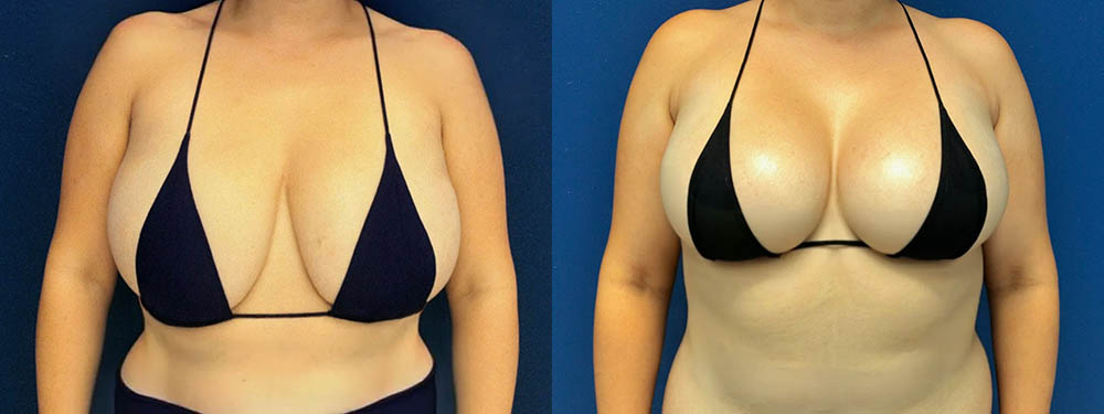 Breast Lift Before and After