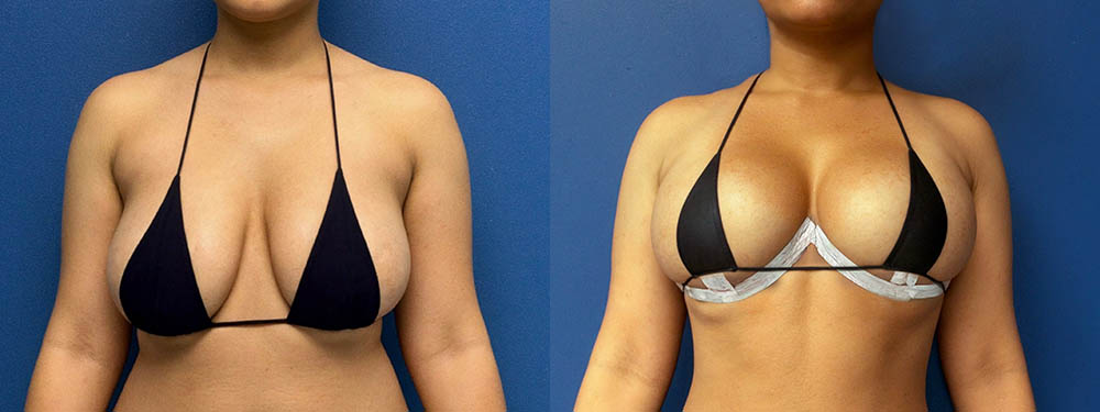 Breast Lift Before and After in Miami